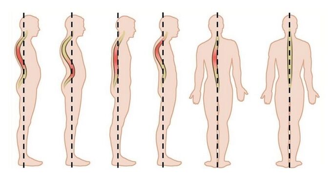 trastornos da postura como causa de osteocondrose torácica