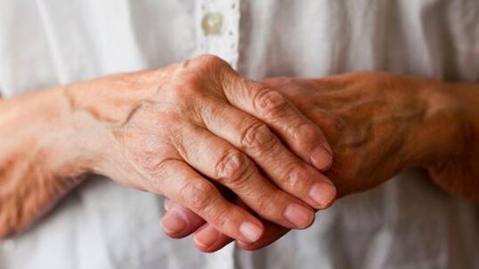 A artrite reumatoide causa dor e inchazo nas articulacións dos dedos. 