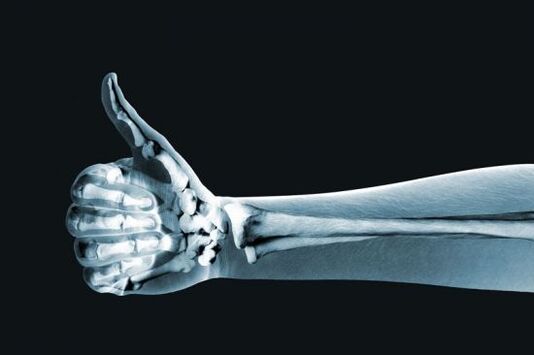 Os raios X poden axudar a diagnosticar a dor nas articulacións dos dedos