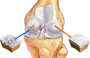 causas da artrose da articulación do xeonllo